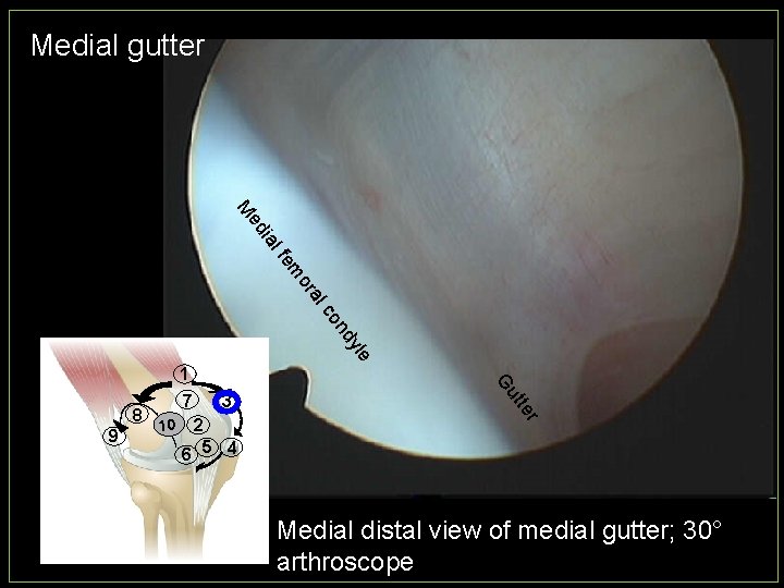 Medial gutter ial ed M yle d on c al or m fe 9