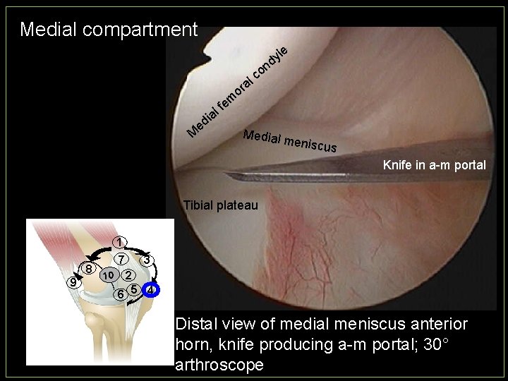 Medial compartment le y d on c al r o em f l ia