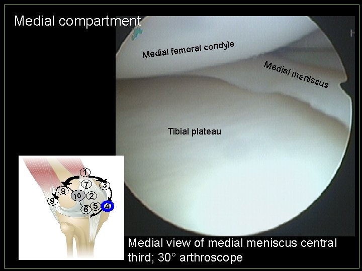 Medial compartment ndyle o c l a r o m Medial fe Med ial