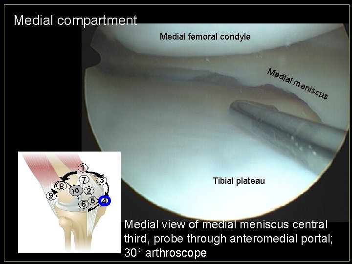 Medial compartment Medial femoral condyle Me dia lm eni scu s 1 8 9