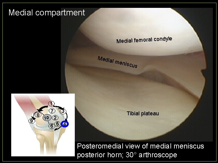 Medial compartment e Medial femoral condyl Media l men iscus 1 8 9 7