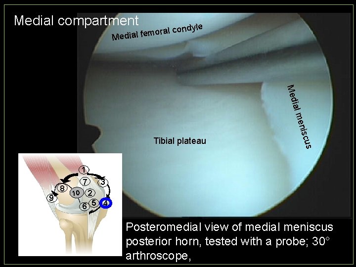 Medial compartment oral m e f l ia d e M condyle Med cus