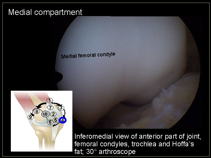 Medial compartment e Medial femoral condyl 1 8 9 7 10 3 2 6
