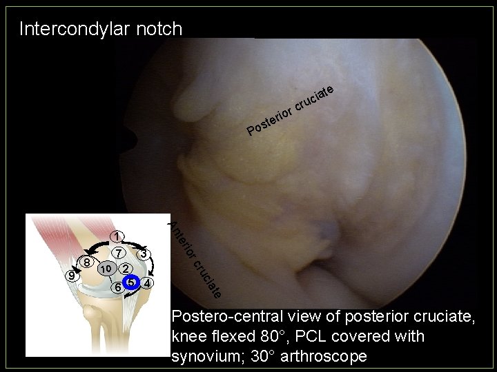 Intercondylar notch Po 10 3 te cia 2 6 5 4 s cru 9