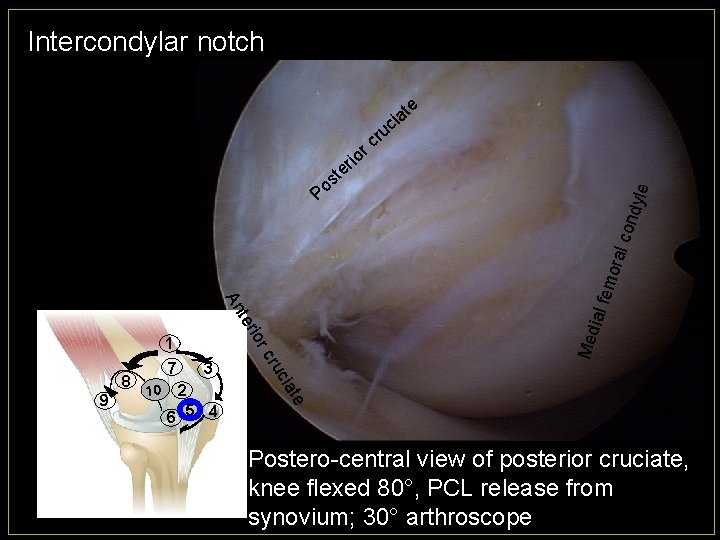 Intercondylar notch cia te u r rc io r e t s o 9