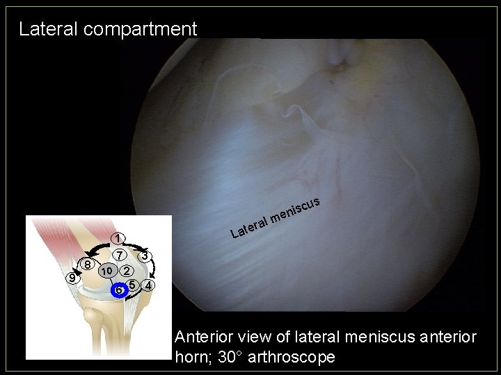 Lateral compartment us c s i n l me era t a L 1