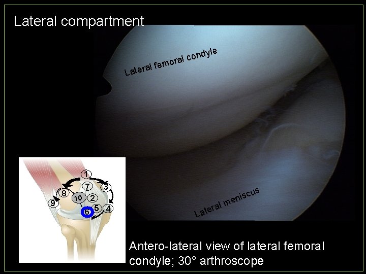 Lateral compartment le ndy o c l ora m e f l a Later