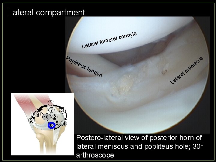 Lateral compartment le em al f r e t a L Po plit ndy