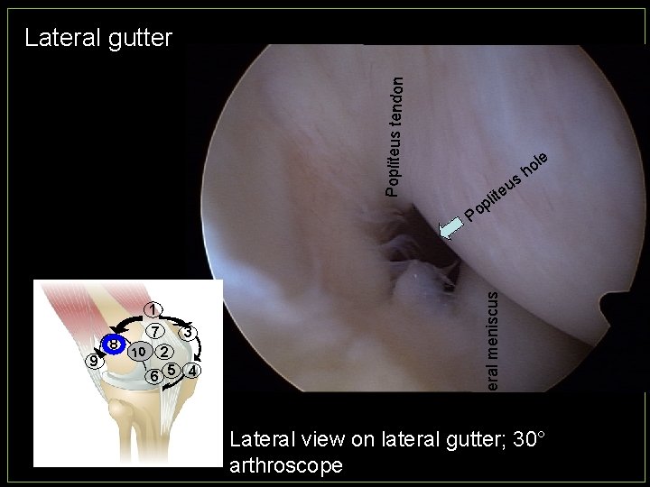 Popliteus tendon Lateral gutter s p 8 9 7 10 3 2 6 5