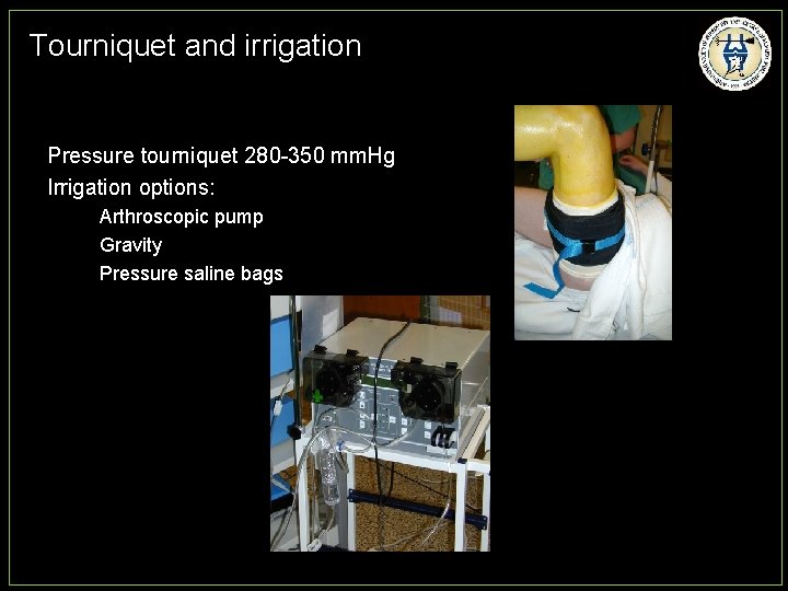Tourniquet and irrigation Pressure tourniquet 280 -350 mm. Hg Irrigation options: Arthroscopic pump Gravity