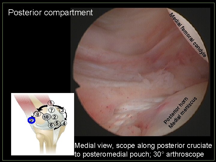 ed M Posterior compartment ial fe on c al or m 8 9 7