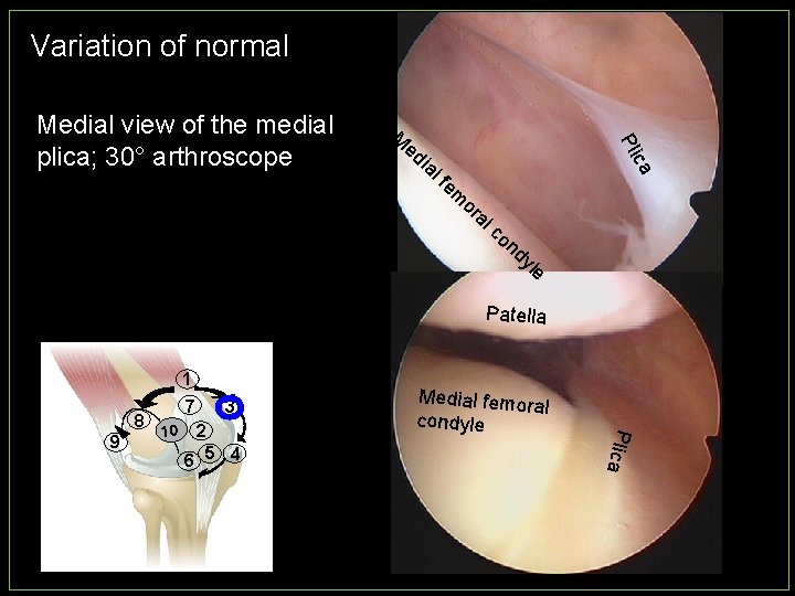 Variation of normal M ia ca ed Pli Medial view of the medial plica;