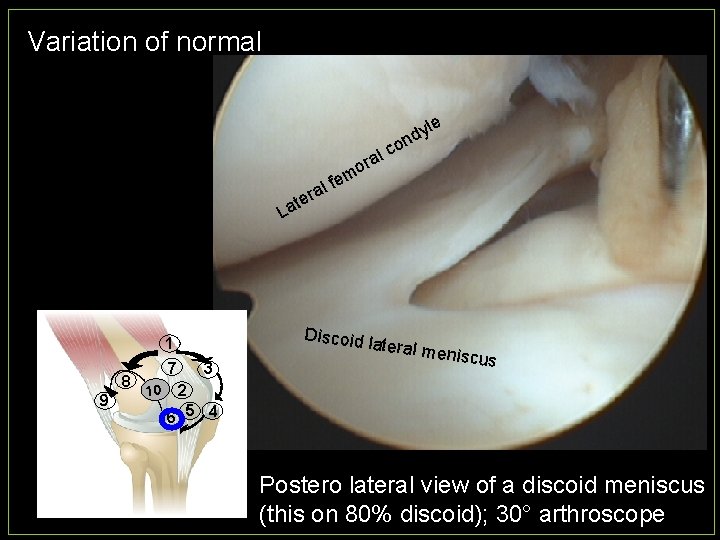 Variation of normal c ral le o y nd o fem l ra e