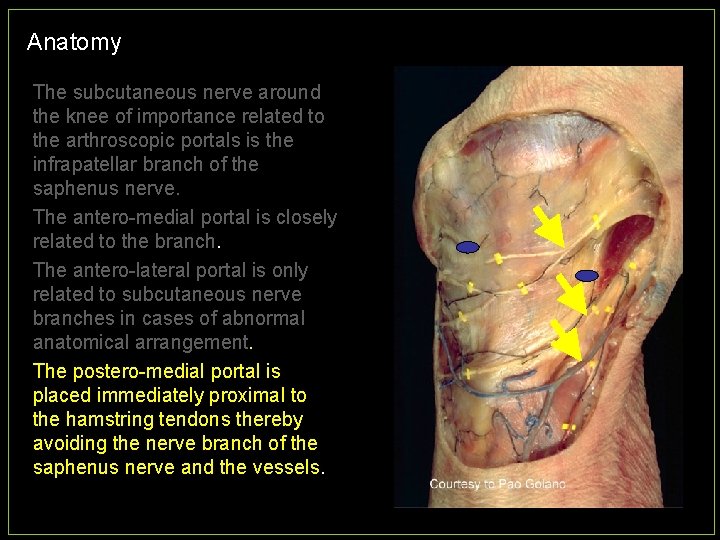 Anatomy The subcutaneous nerve around the knee of importance related to the arthroscopic portals