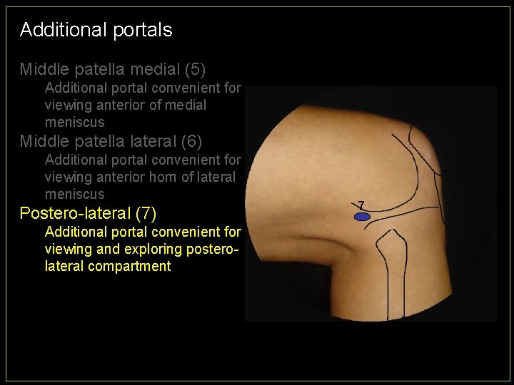 Additional portals Middle patella medial (5) Additional portal convenient for viewing anterior of medial