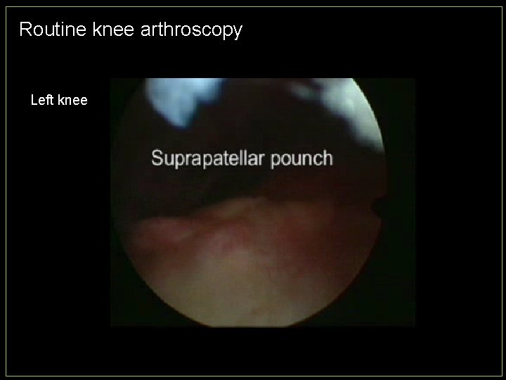 Routine knee arthroscopy Left knee 