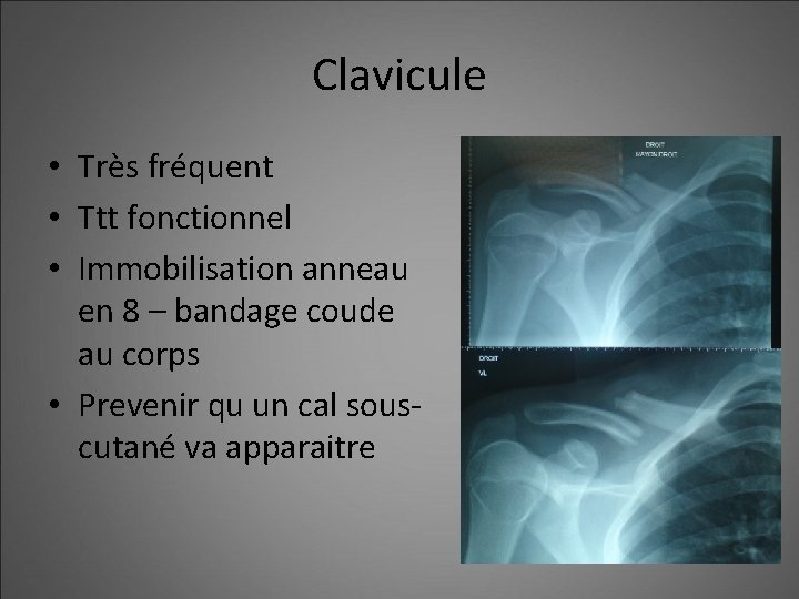 Clavicule • Très fréquent • Ttt fonctionnel • Immobilisation anneau en 8 – bandage