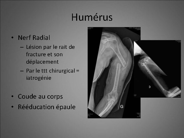 Humérus • Nerf Radial – Lésion par le rait de fracture et son déplacement