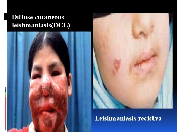 Diffuse cutaneous leishmaniasis(DCL) Leishmaniasis recidiva 