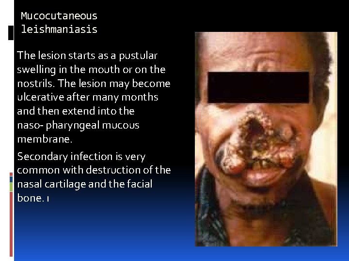 Mucocutaneous leishmaniasis The lesion starts as a pustular swelling in the mouth or on