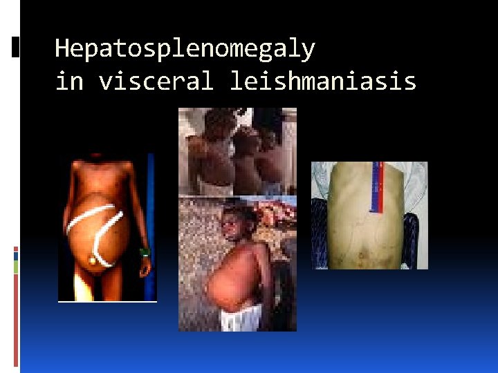 Hepatosplenomegaly in visceral leishmaniasis 