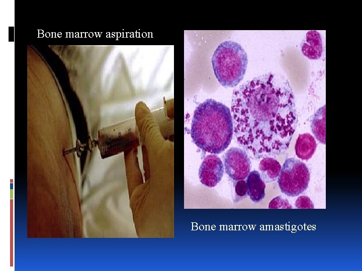Bone marrow aspiration Bone marrow amastigotes 