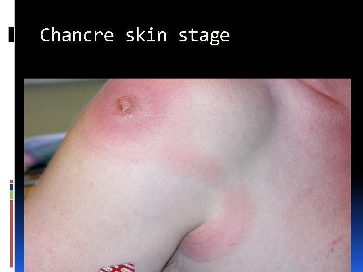 Chancre skin stage 