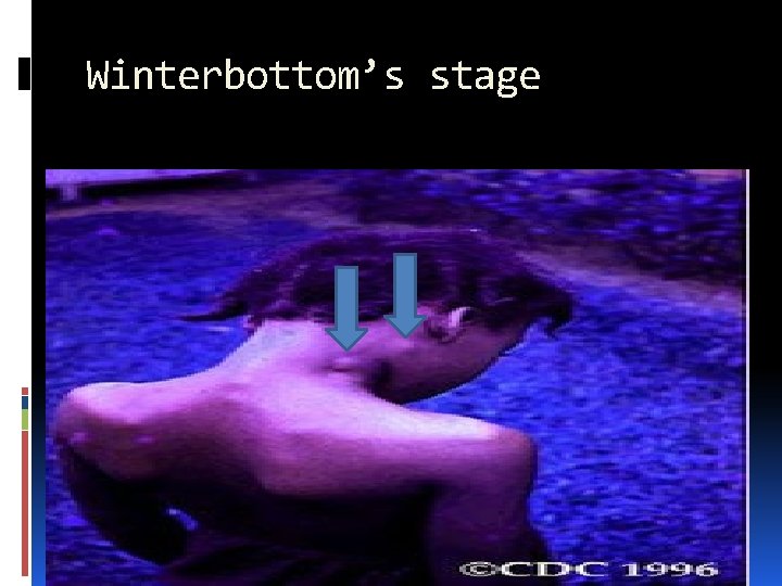 Winterbottom’s stage 