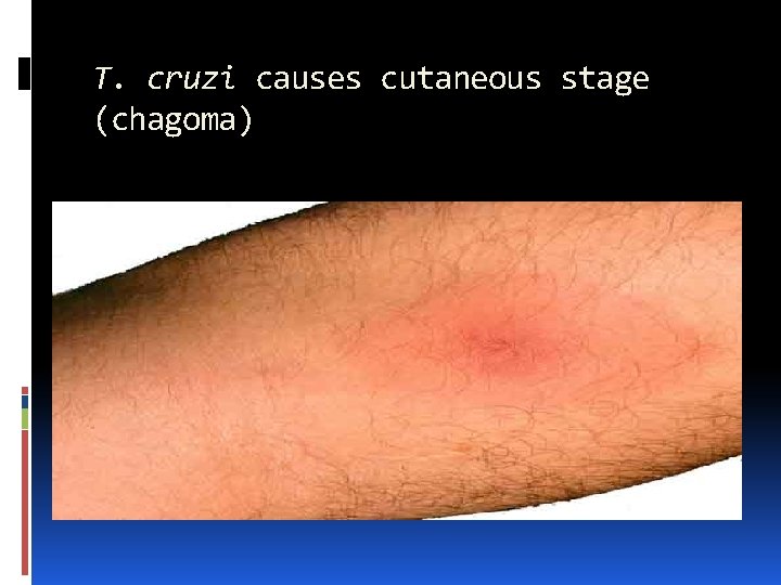 T. cruzi causes cutaneous stage (chagoma) 