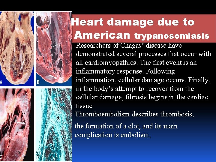 Heart damage due to American trypanosomiasis Researchers of Chagas’ disease have demonstrated several processes