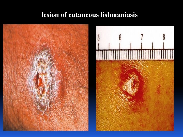 lesion of cutaneous lishmaniasis 