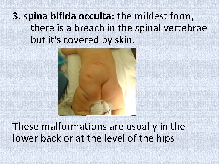 3. spina bifida occulta: the mildest form, there is a breach in the spinal