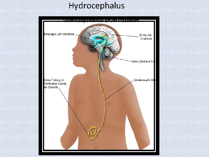 Hydrocephalus 