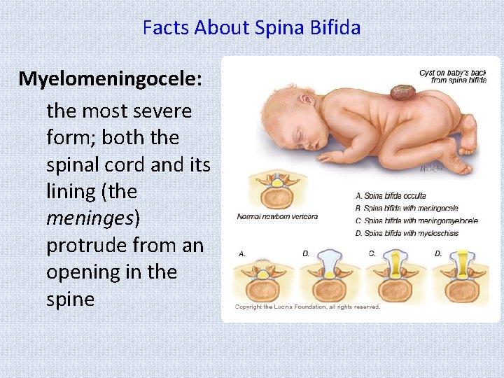 Facts About Spina Bifida Myelomeningocele: the most severe form; both the spinal cord and