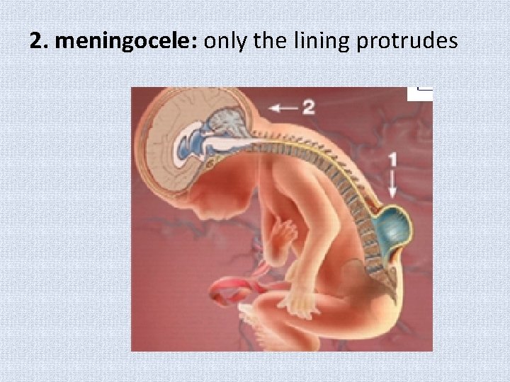 2. meningocele: only the lining protrudes 