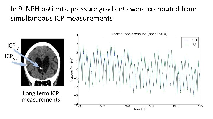 In 9 i. NPH patients, pressure gradients were computed from simultaneous ICP measurements 