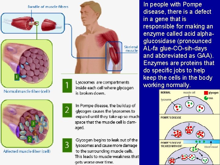 In people with Pompe disease, there is a defect in a gene that is