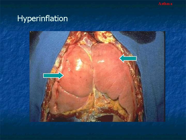 Asthma Hyperinflation 