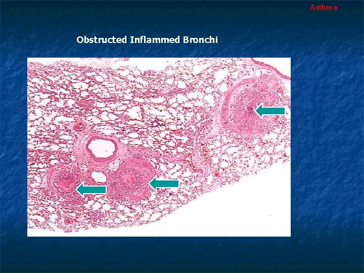 Asthma Obstructed Inflammed Bronchi 