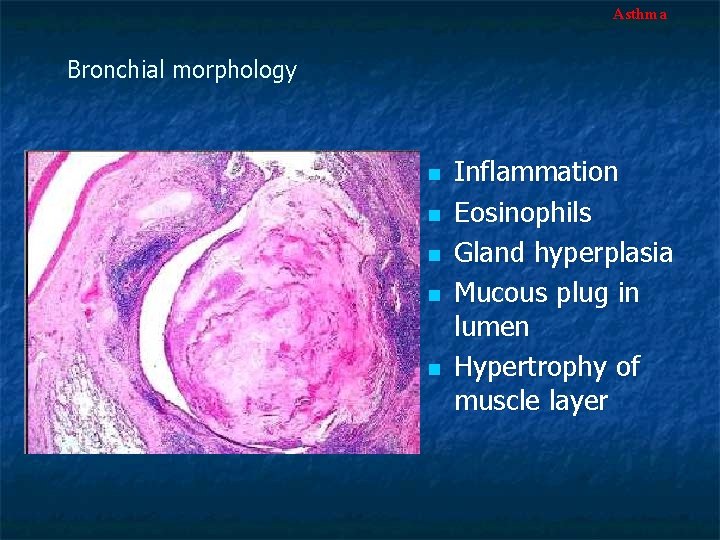 Asthma Bronchial morphology n n n Inflammation Eosinophils Gland hyperplasia Mucous plug in lumen