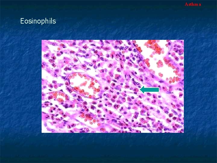 Asthma Eosinophils 