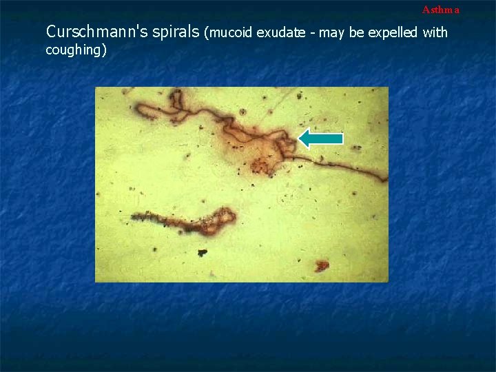 Asthma Curschmann's spirals (mucoid exudate - may be expelled with coughing) 