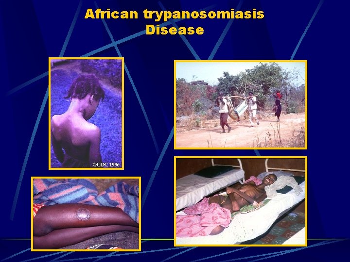 African trypanosomiasis Disease 