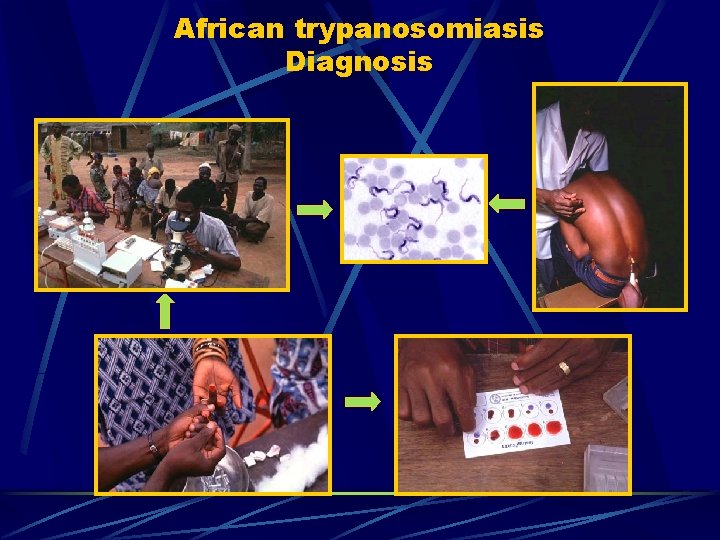 African trypanosomiasis Diagnosis African trypanosomiasis Diagnosis