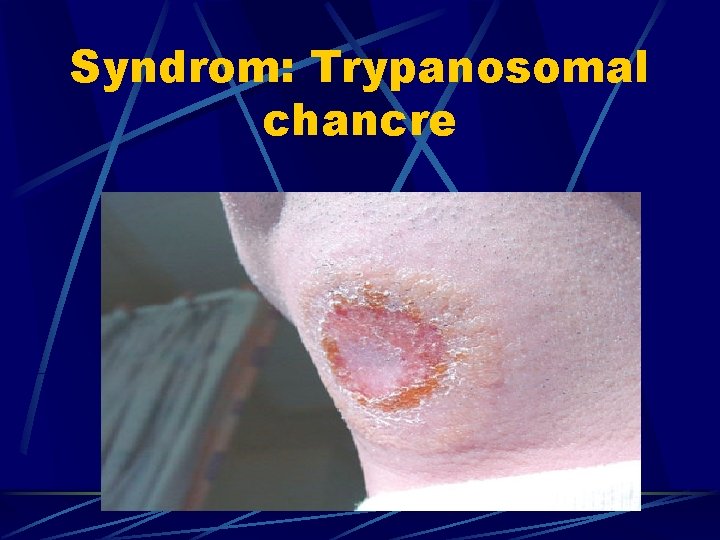 Syndrom: Trypanosomal chancre 