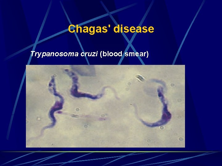 Chagas' disease Trypanosoma cruzi (blood smear) 