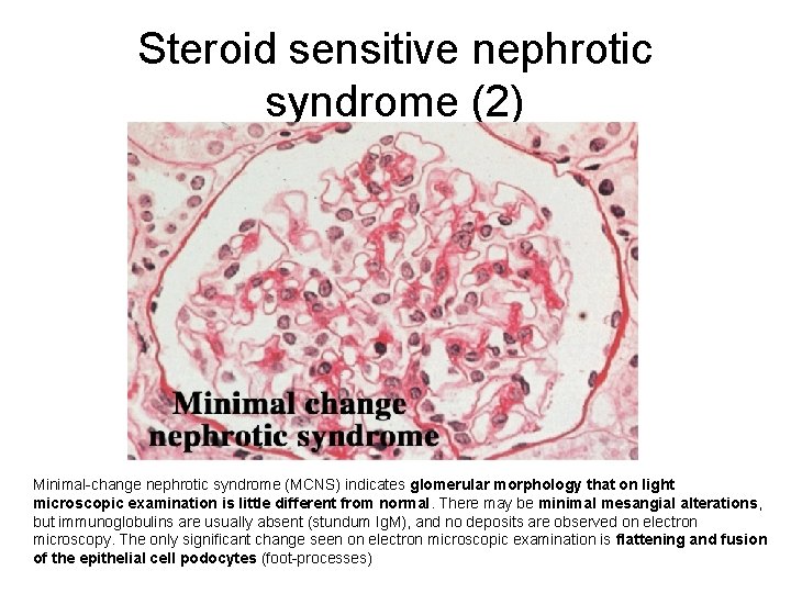 Steroid sensitive nephrotic syndrome (2) Minimal-change nephrotic syndrome (MCNS) indicates glomerular morphology that on