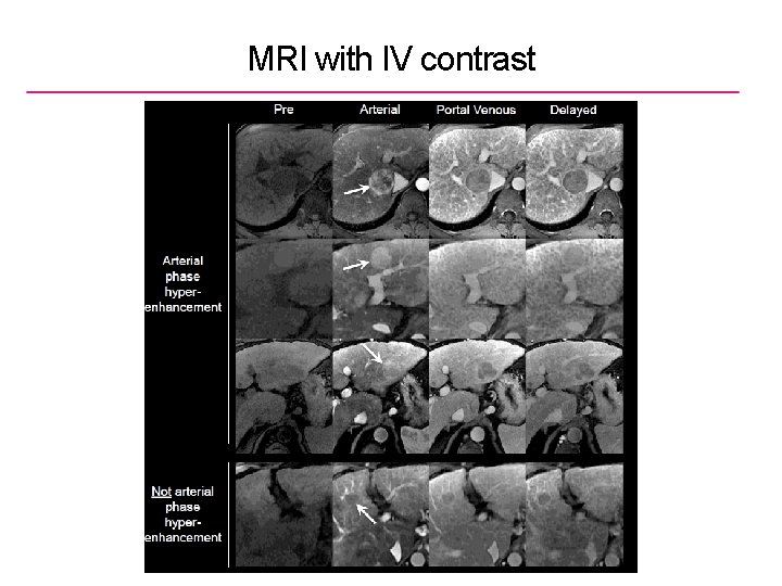 MRI with IV contrast 