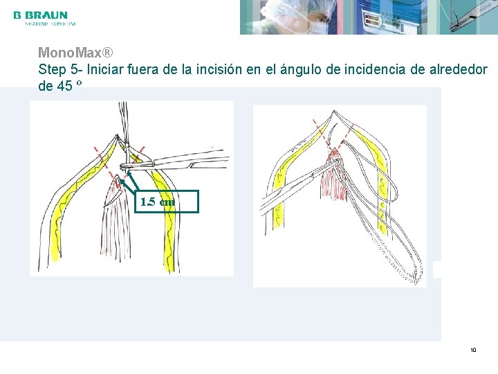 Mono. Max® Step 5 - Iniciar fuera de la incisión en el ángulo de