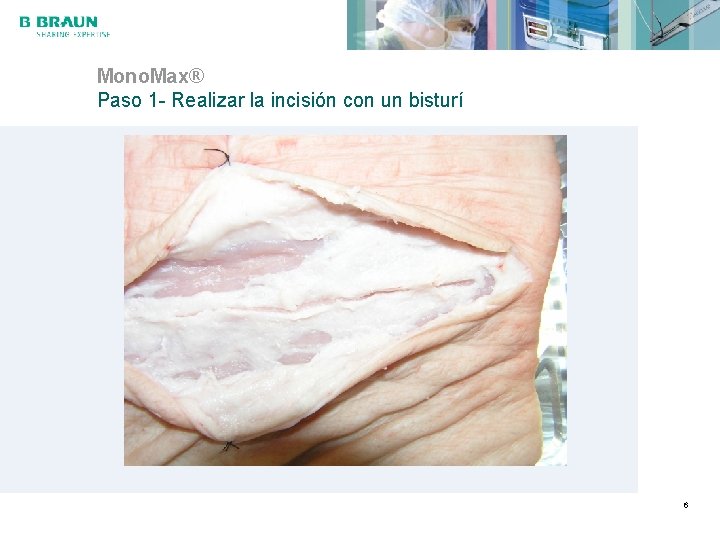 Mono. Max® Paso 1 - Realizar la incisión con un bisturí 6 